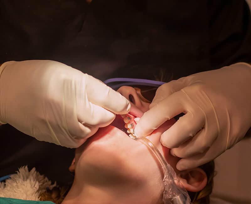 Zabieg zakładania aparatu ortodontycznego